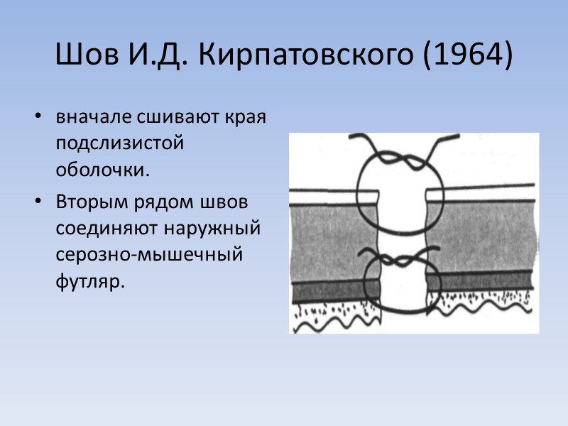 Шов И.Д. Кирпатовского (1964) вначале сшивают края подслизистой оболочки. Вторым рядом швов соединяют наружный